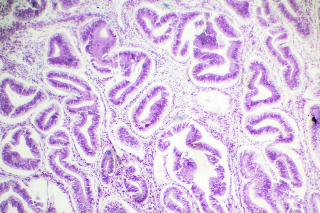 Adenomyosis: Symptoms, Diagnosis & Treatment